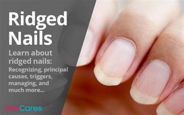 How to Get Rid of Nail Ridges: A Comprehensive Guide
