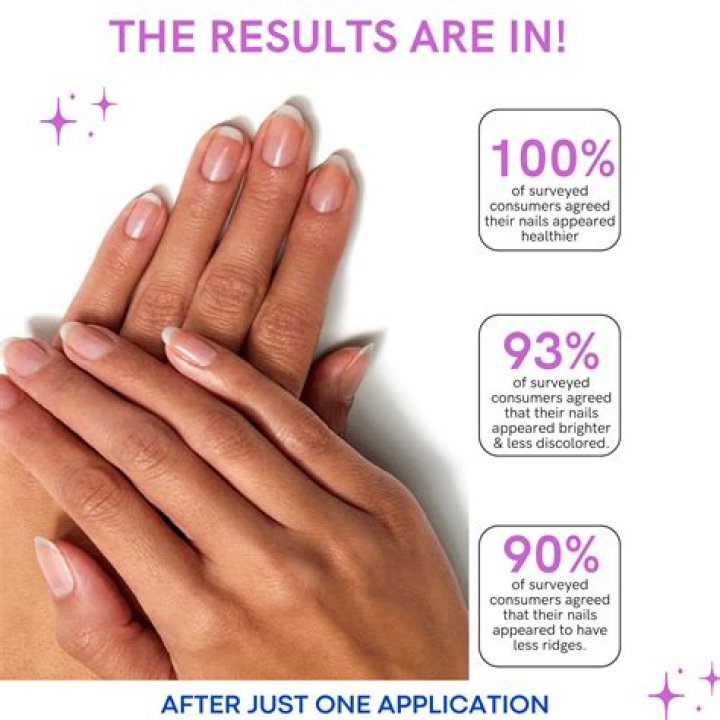 Nail Ridges Treatment: Comprehensive Guide for Smooth and Healthy Nails